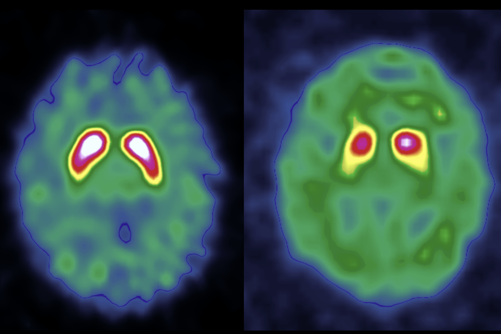 GitHub - drivendataorg/dat-parkinsons: Competition winners' code for ...